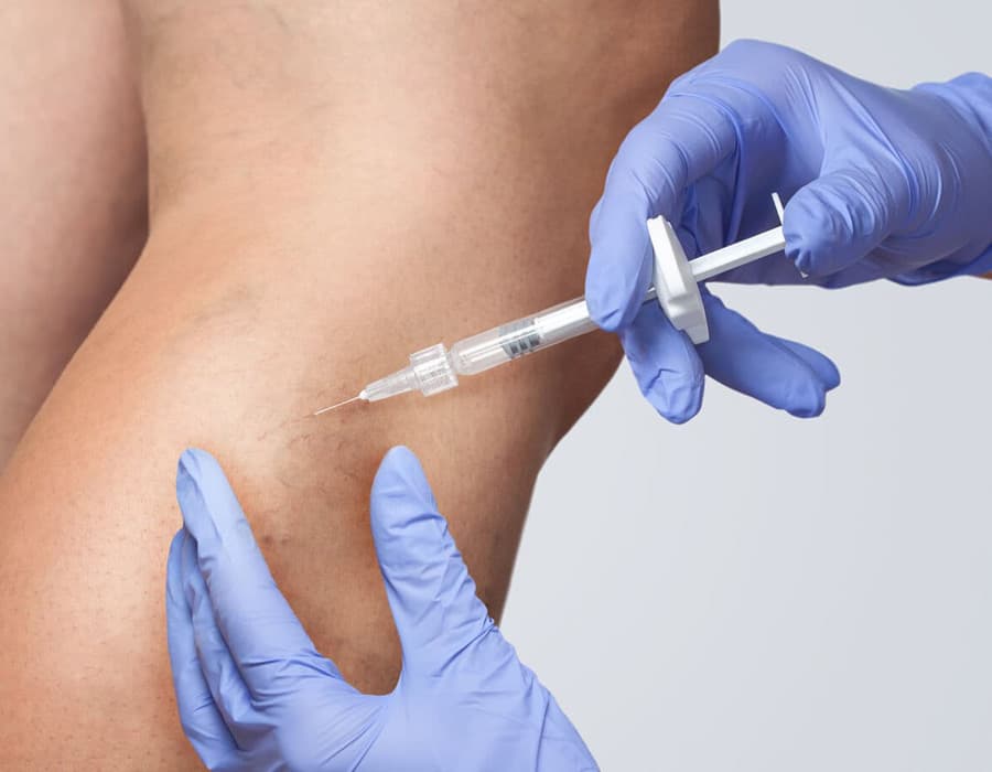 Escleroterapia